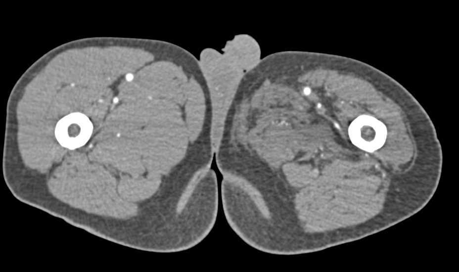 Reconstructed Left External Iliac Through Superficial Femoral Artery (SFA) in Patient with Tumor Infiltration into the Pelvis and Sarcoma in Thigh - CTisus CT Scan