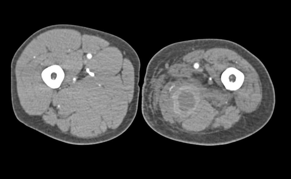 Reconstructed Left External Iliac Through Superficial Femoral Artery (SFA) in Patient with Tumor Infiltration into the Pelvis and Sarcoma in Thigh - CTisus CT Scan