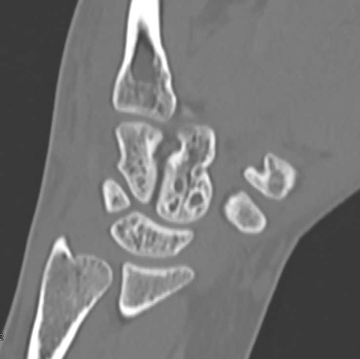 Cystic Changes Carpal Bones Musculoskeletal Case Studies Ctisus Ct