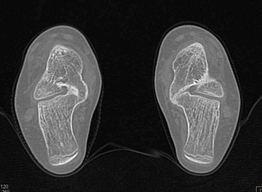 Bilateral Tarsal Coalition - CTisus CT Scan