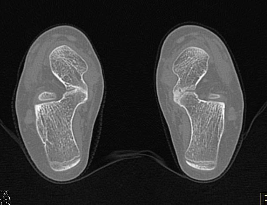 Bilateral Tarsal Coalition - CTisus CT Scan