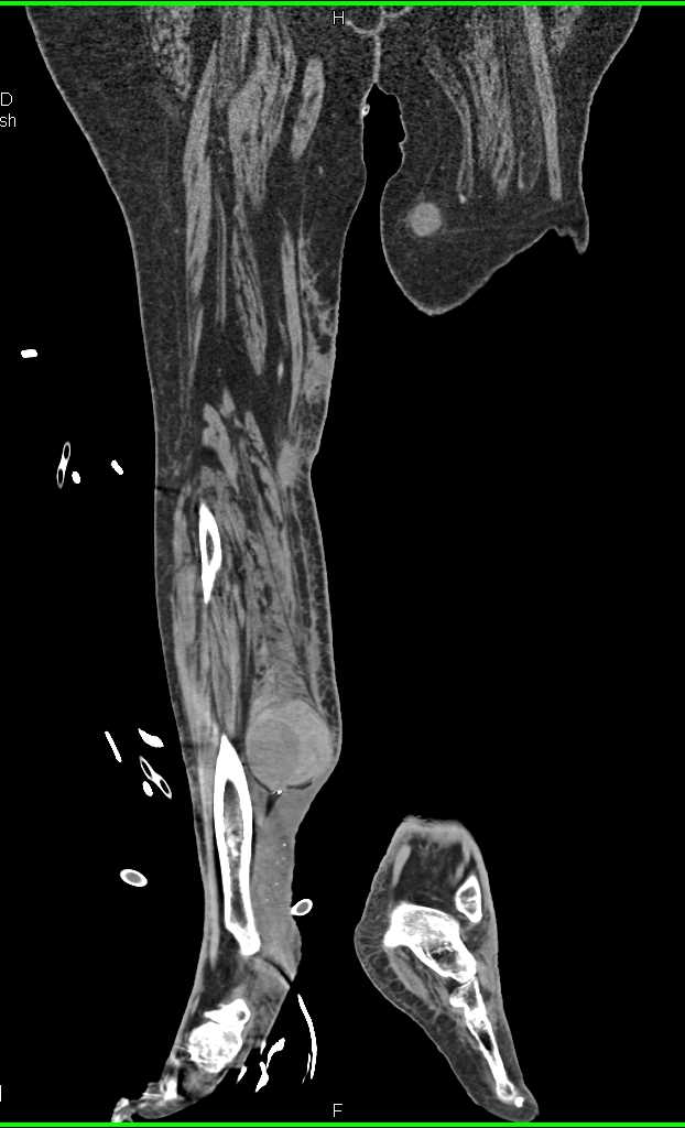 Hematoma in Right Calf - CTisus CT Scan