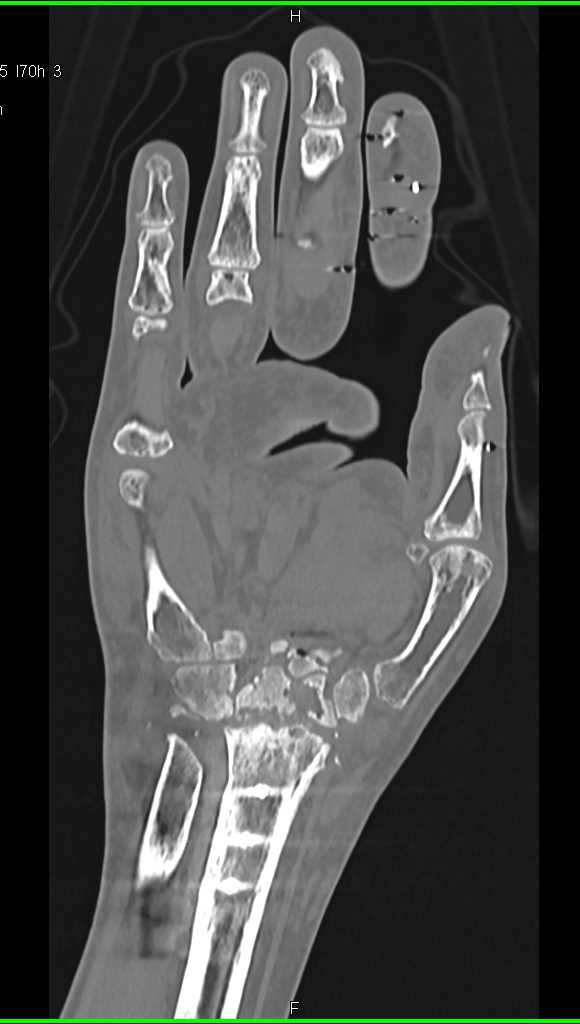 Cystic Changes in the Carpal Bones and Degenerative Joint Disease (DJD) in Joint Space - CTisus CT Scan