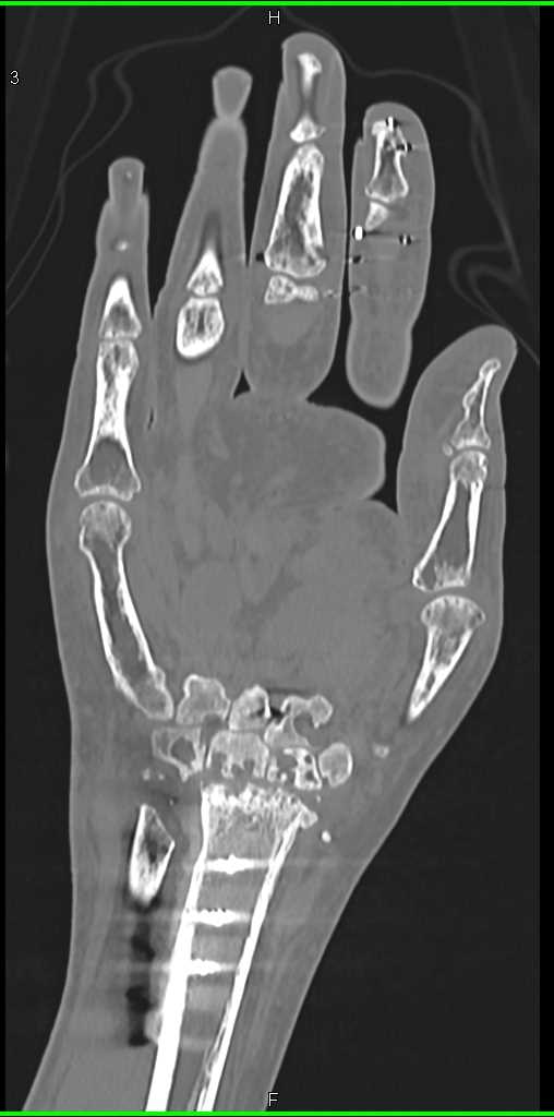 Cystic Changes in the Carpal Bones and Degenerative Joint Disease (DJD) in Joint Space - CTisus CT Scan