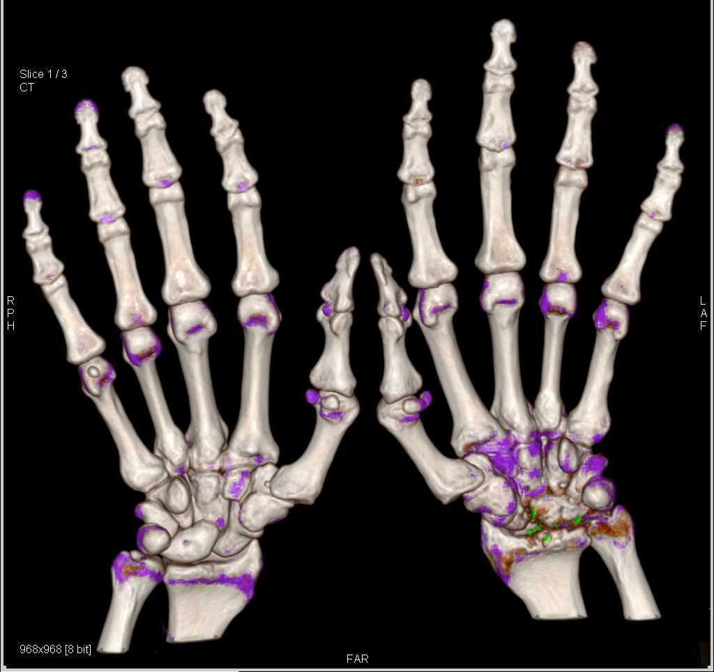 Dual Energy Defines Gout in Multiple Joints - CTisus CT Scan