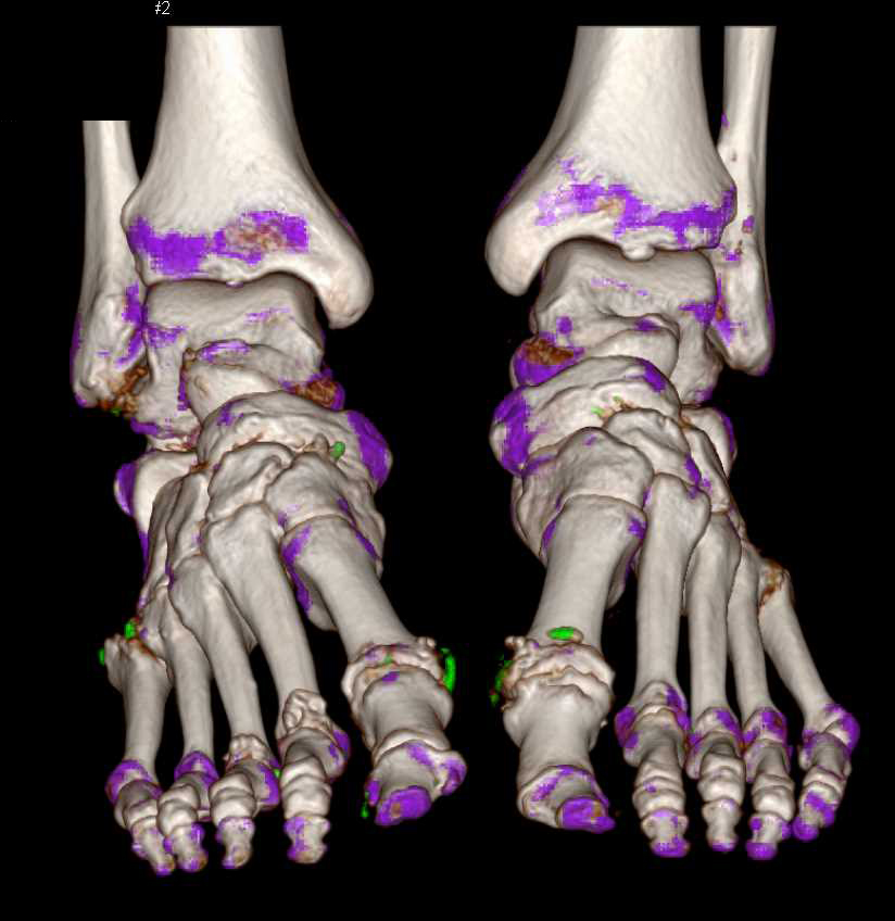 Dual Energy Defines Gout in Multiple Joints - CTisus CT Scan