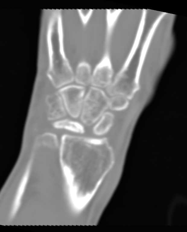 Fracture with Avascular Necrosis (AVN) Lunate - CTisus CT Scan