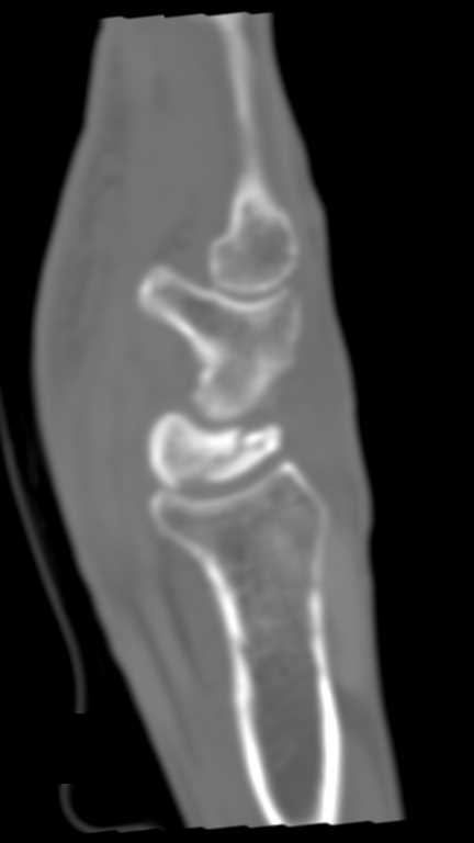 Fracture with Avascular Necrosis (AVN) Lunate - CTisus CT Scan