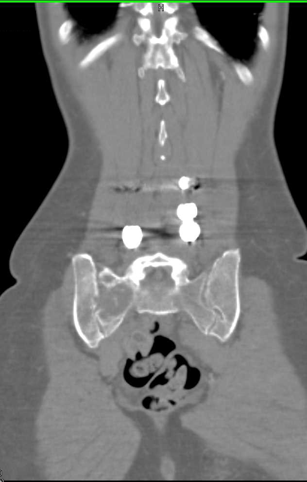 Ewing Sarcoma with Metastases - CTisus CT Scan