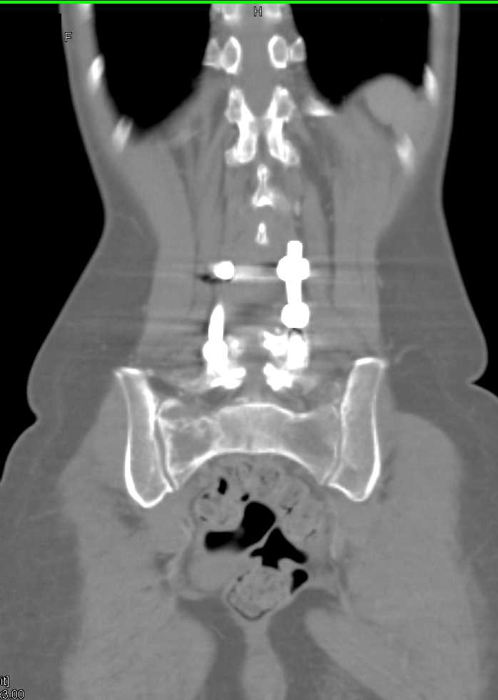 Lymphoma of Bone - CTisus CT Scan