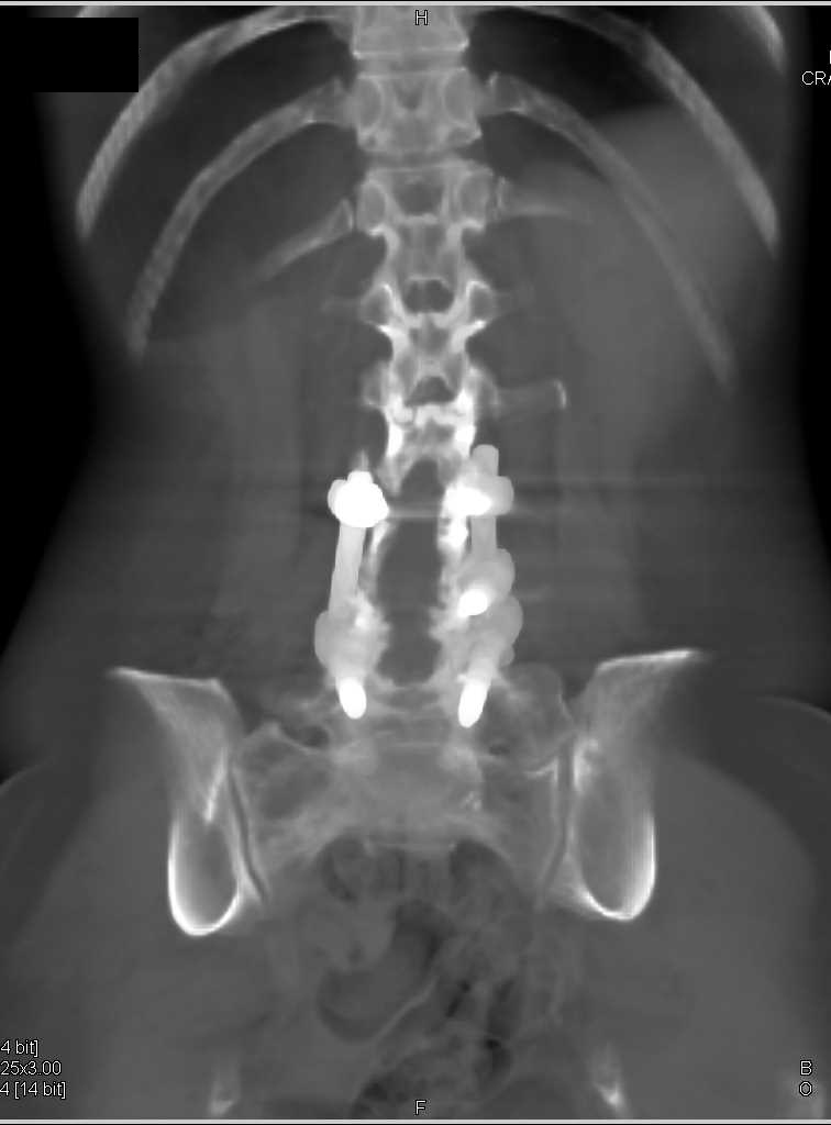 Ewing Sarcoma Sacrum - CTisus CT Scan