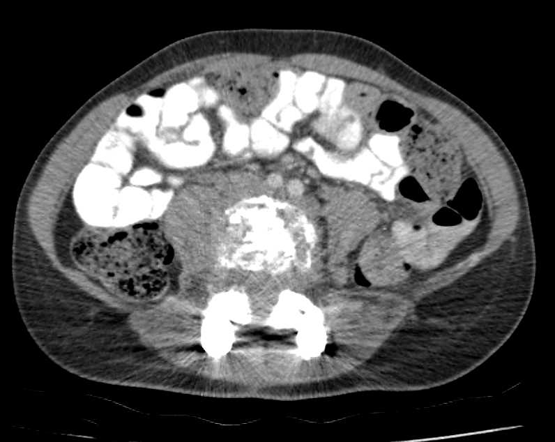 Lymphoma of Bone - CTisus CT Scan