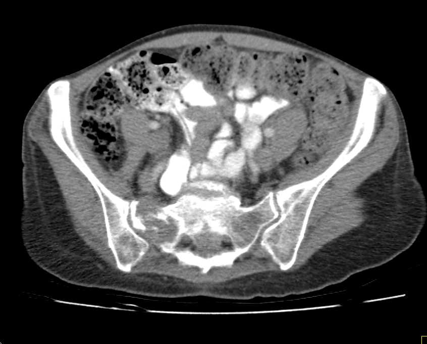 Lymphoma of Bone with Multiple Sites of Involvement - CTisus CT Scan