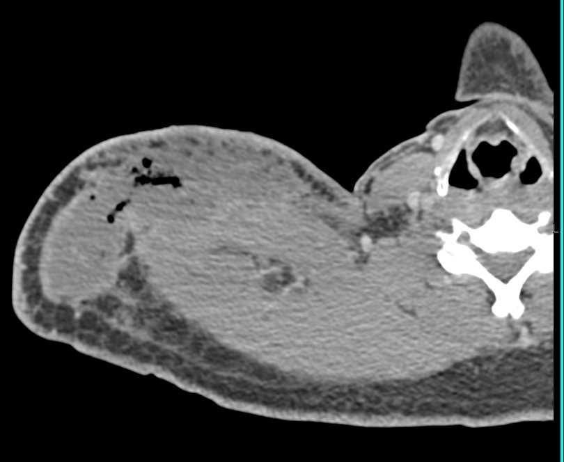 Abscess in Deltoid Muscle Right Shoulder - CTisus CT Scan