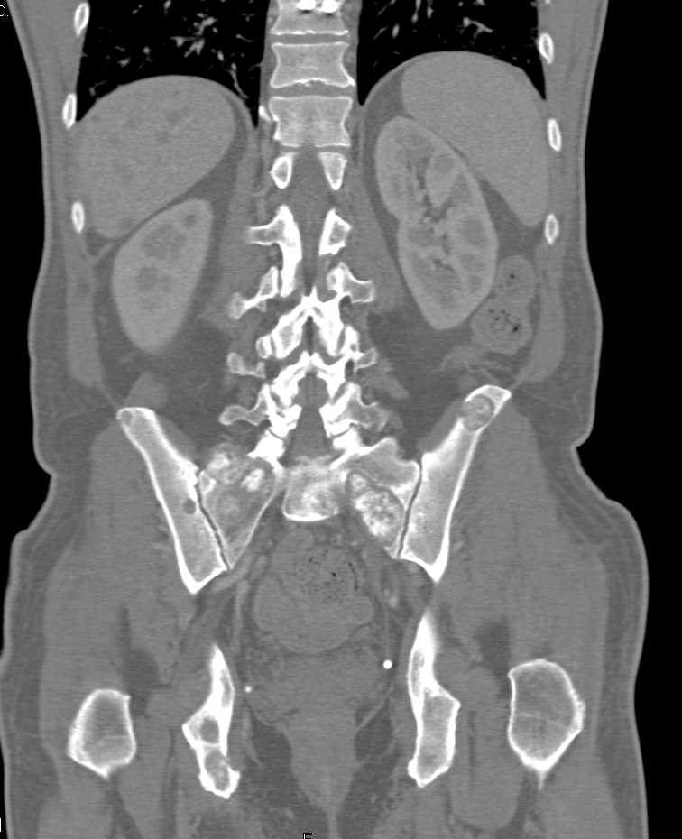 Metastatic Lung Carcinoma to the Liver and Bone - CTisus CT Scan