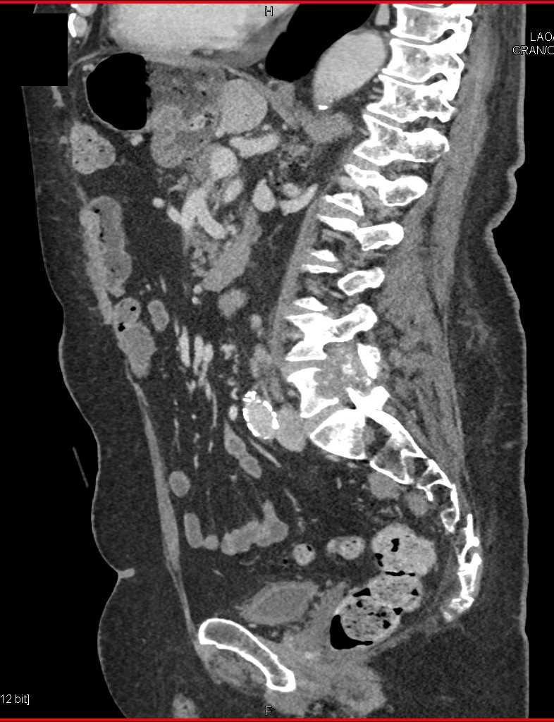 Metastatic Lung Carcinoma to the Liver and Bone - CTisus CT Scan