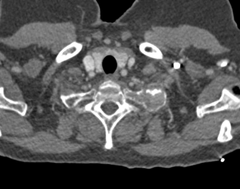 Expansile Rib Lesion Possibly Bone Cyst Post Trauma - CTisus CT Scan