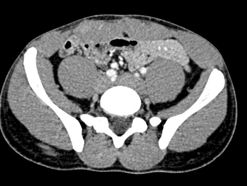 Desmoid Tumor Abdominal Wall - CTisus CT Scan