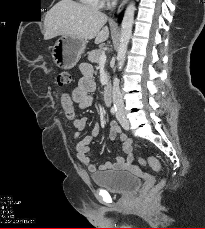 Midline Ventral Hernias - CTisus CT Scan