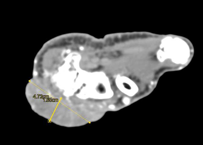 Squammous Cell Carcinoma on Wrist - CTisus CT Scan