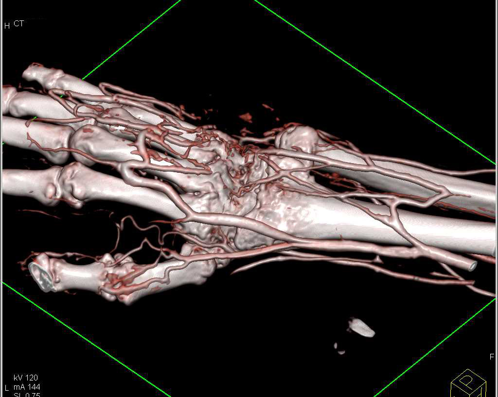 Squammous Cell Carcinoma on Wrist - CTisus CT Scan