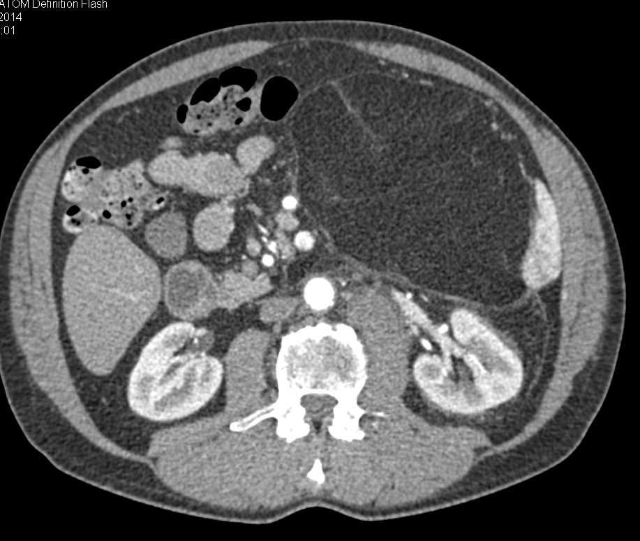 Retroperitoneal Liposarcoma - CTisus CT Scan