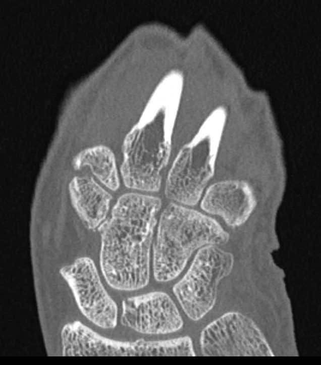 Degenerative Arthritis - CTisus CT Scan