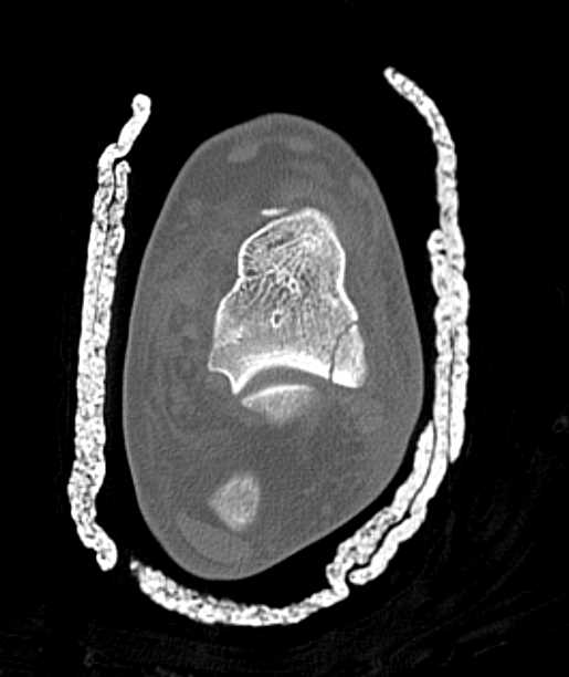 Talus Fracture - CTisus CT Scan