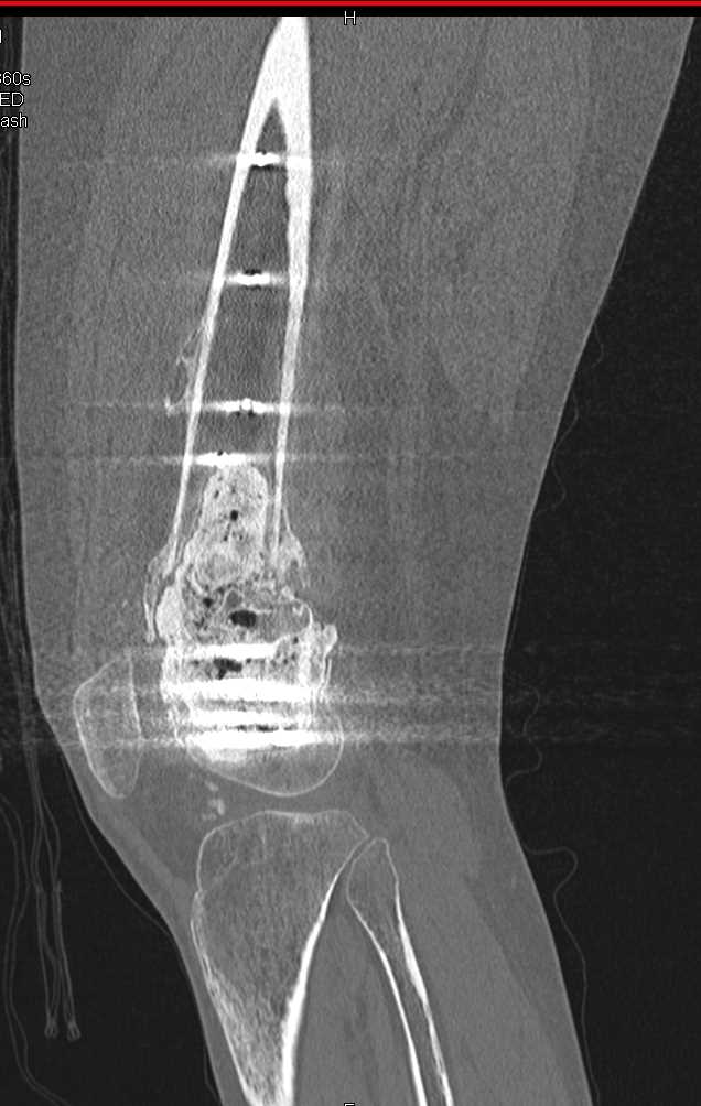 Cement and Hardware for Resection of Femur Tumor - CTisus CT Scan