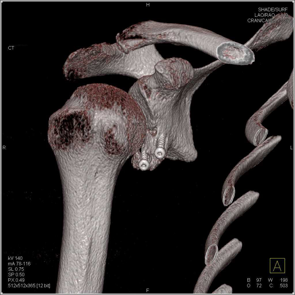 Pins with Repair of Glenoid Fracture - CTisus CT Scan