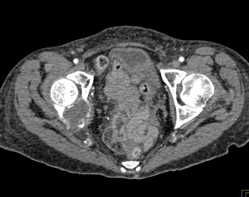 Metastatic Renal Cell Carcinoma to the Right Acetabulum - CTisus CT Scan