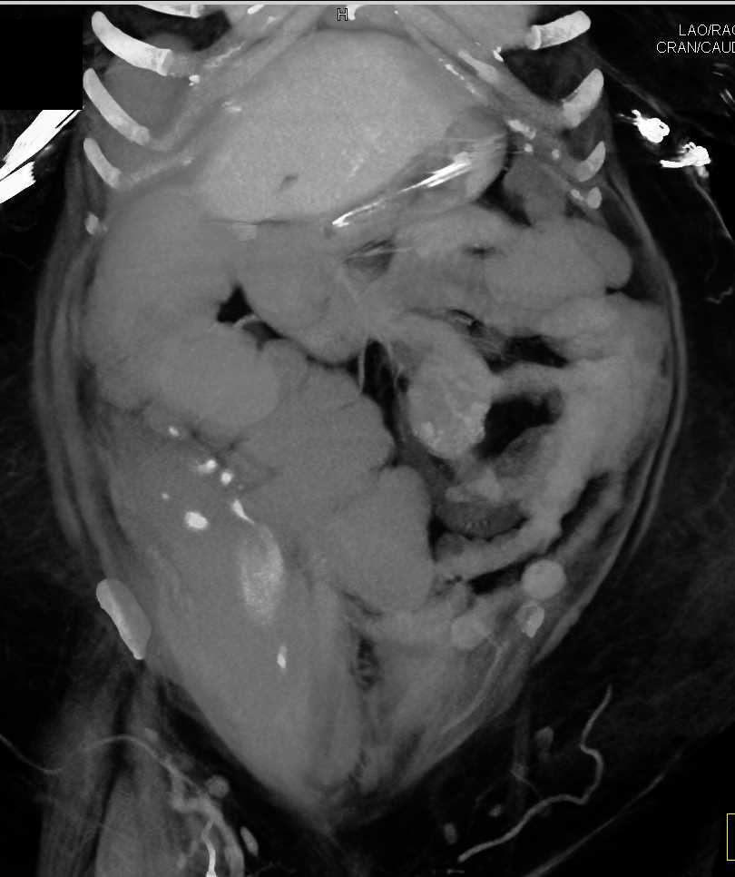 Rectus Hematoma with Active Bleed - CTisus CT Scan