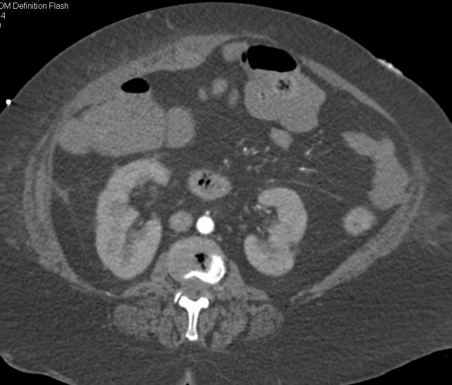 Rectus Hematoma with Active Bleed - CTisus CT Scan