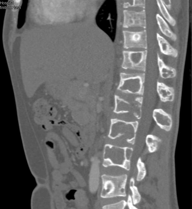 Fibrous Dysplasia - CTisus CT Scan