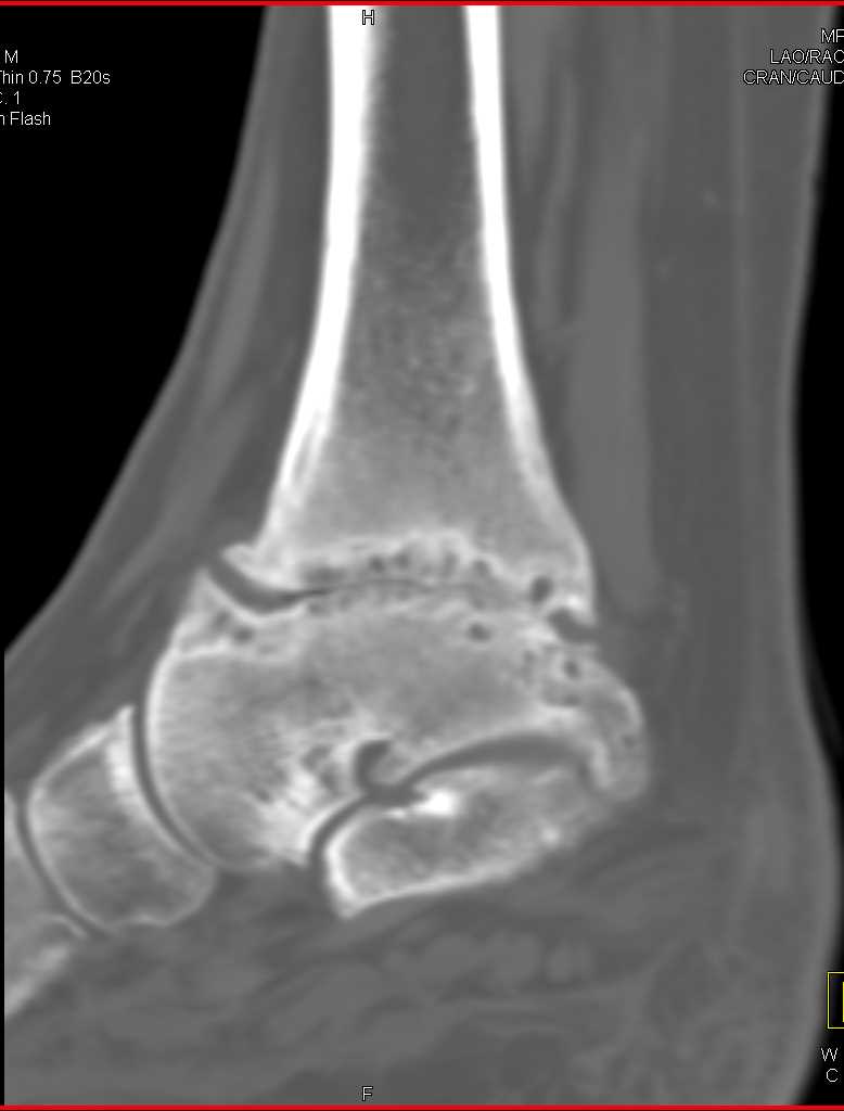 Degenerative Change in the Ankle Joint - CTisus CT Scan