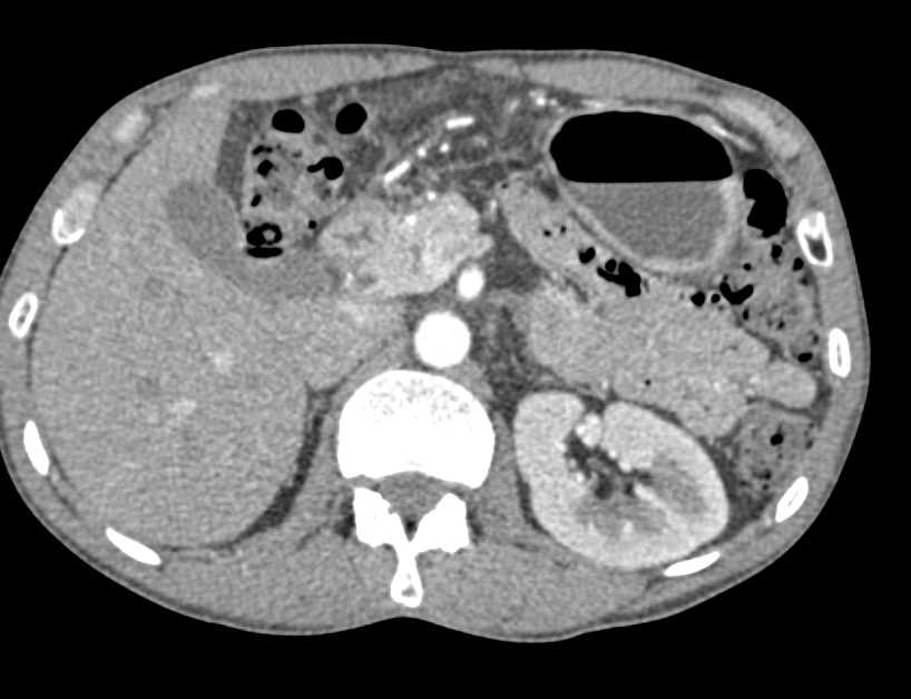 Trauma with Left Acetabular Fracture and Pelvic Hematoma - CTisus CT Scan
