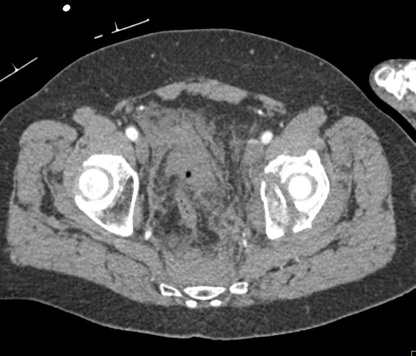Acetabular Fracture with Pelvic Hematoma - CTisus CT Scan