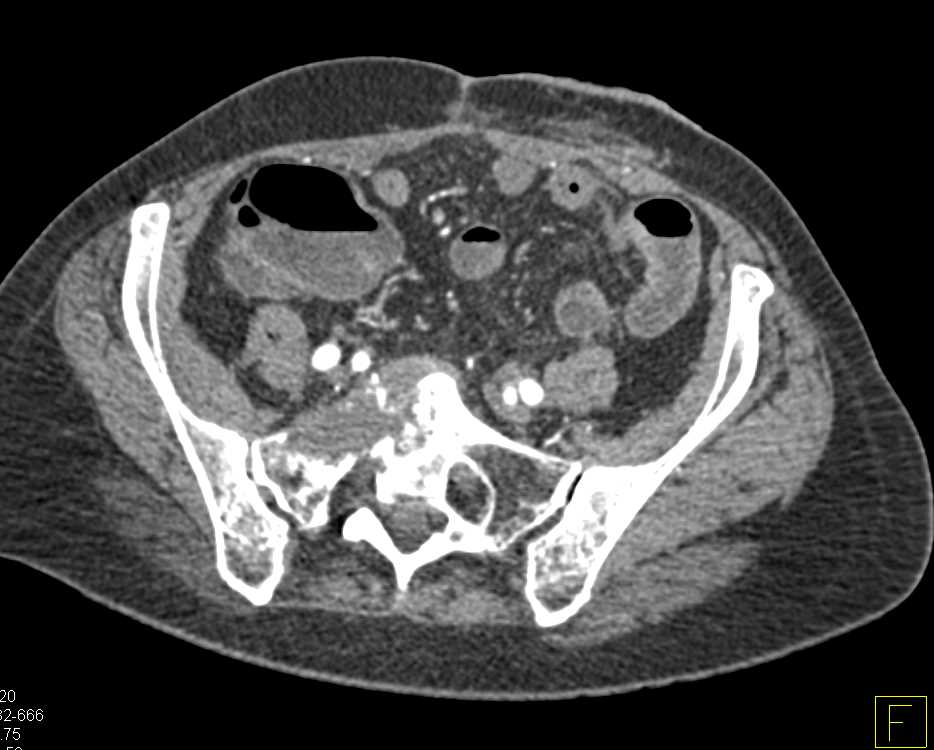 Metastatic Renal Cell Carcinoma to the Sacrum - CTisus CT Scan