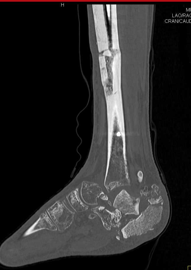 Complex Ankle Fragments in a Neuropathic Joint - CTisus CT Scan