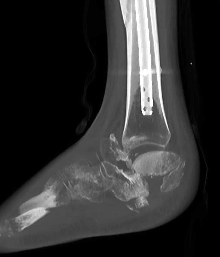 Complex Ankle Fragments in a Neuropathic Joint - Musculoskeletal Case