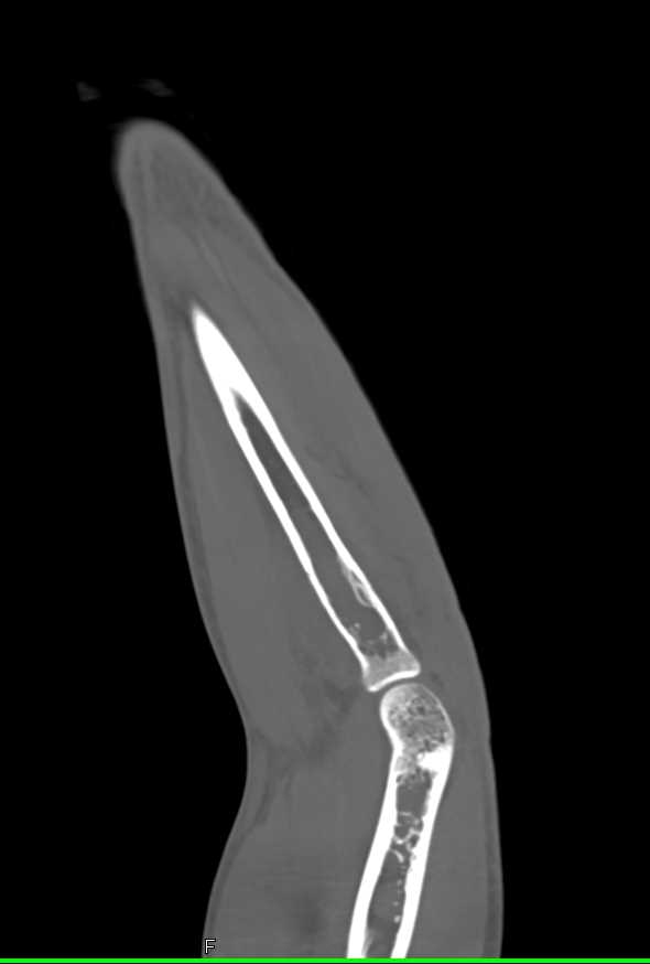 Ewing Sarcoma with Bone Infiltration - CTisus CT Scan