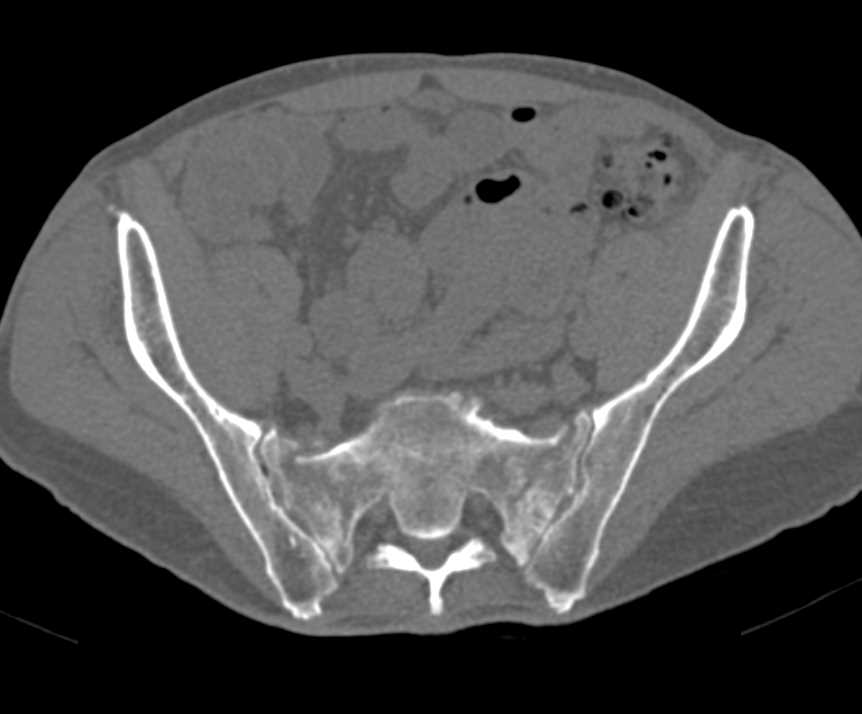 Bilateral Sacral Stress Fractures - CTisus CT Scan