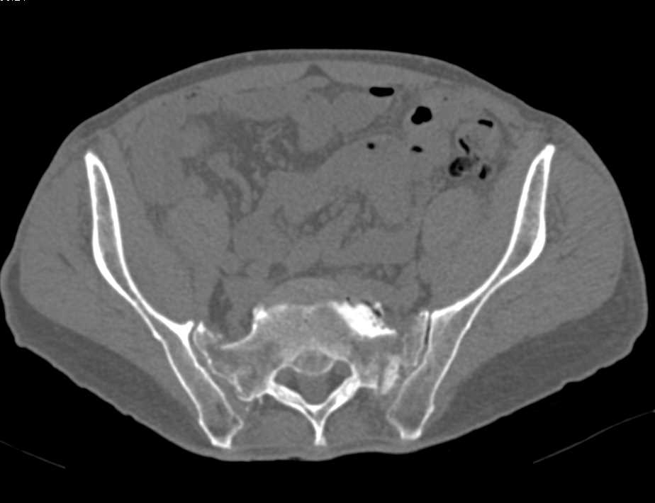 Bilateral Sacral Stress Fractures - CTisus CT Scan