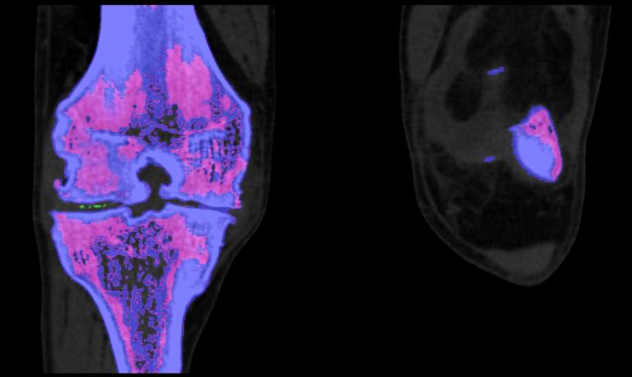 Dual Energy with Elevated Urate Crystals Right Knee c/w Gout - CTisus CT Scan