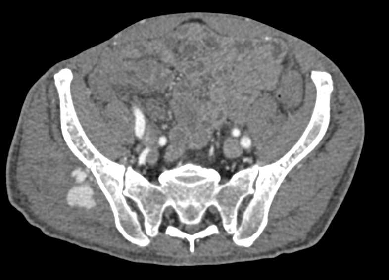 Pseudo-aneurysm Right Gluteus Muscle in Patient wit Prior Biopsy of the Iliac Crest - CTisus CT Scan