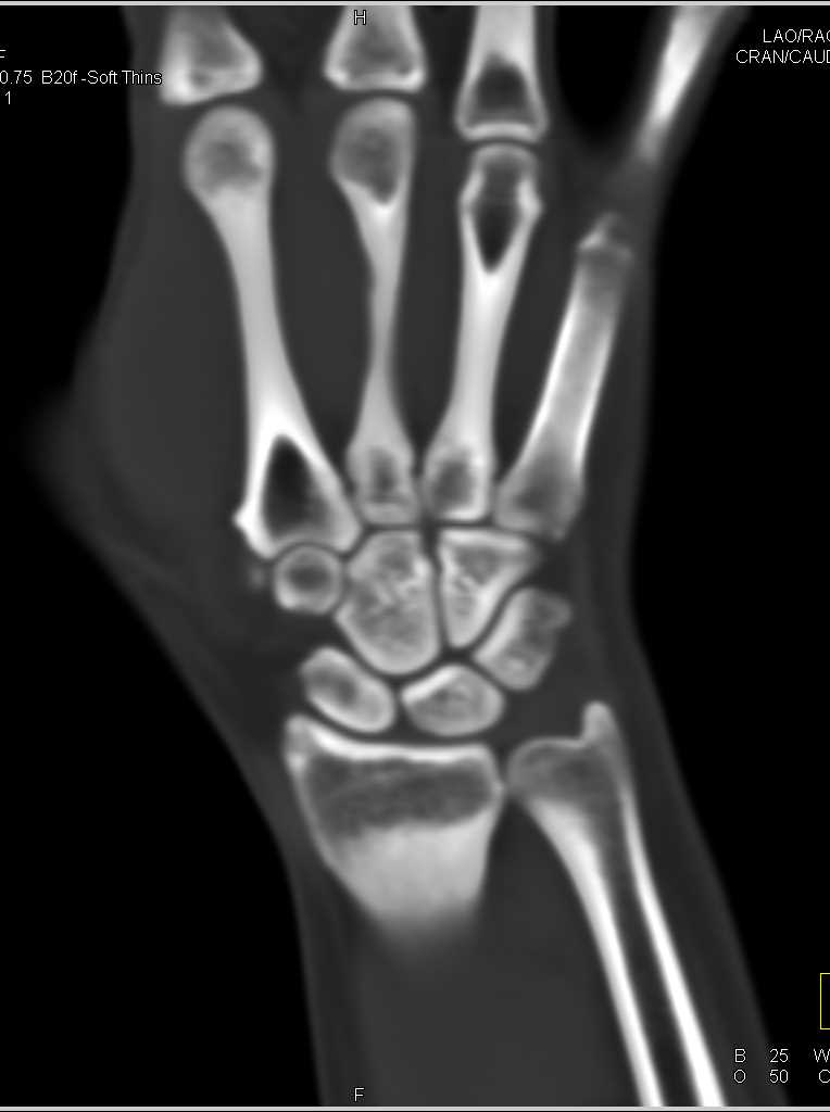 CT Carpal Bones Without a Fracture - CTisus CT Scan