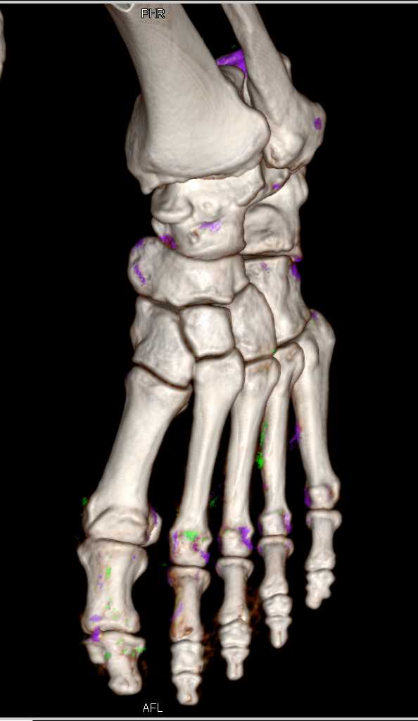 Dual Energy Example of Gout - CTisus CT Scan