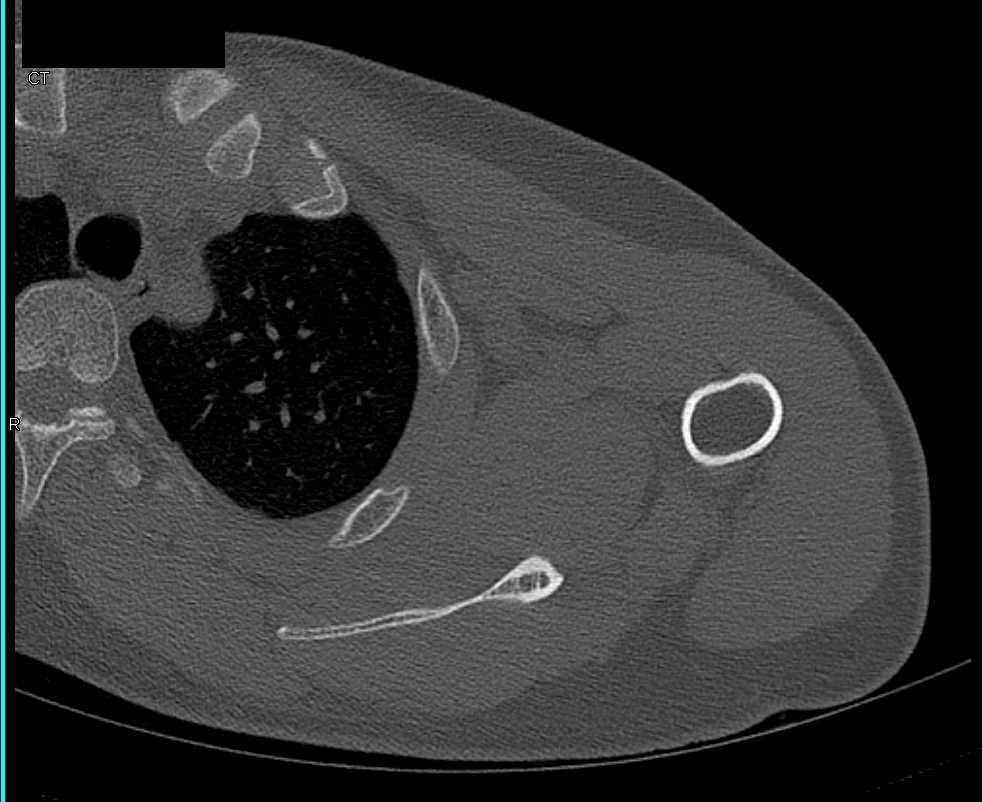 Scapular Fracture s/p Trauma - CTisus CT Scan