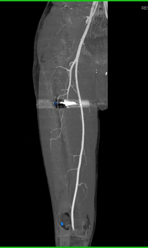 GSW Thigh Without Vascular Injury - CTisus CT Scan