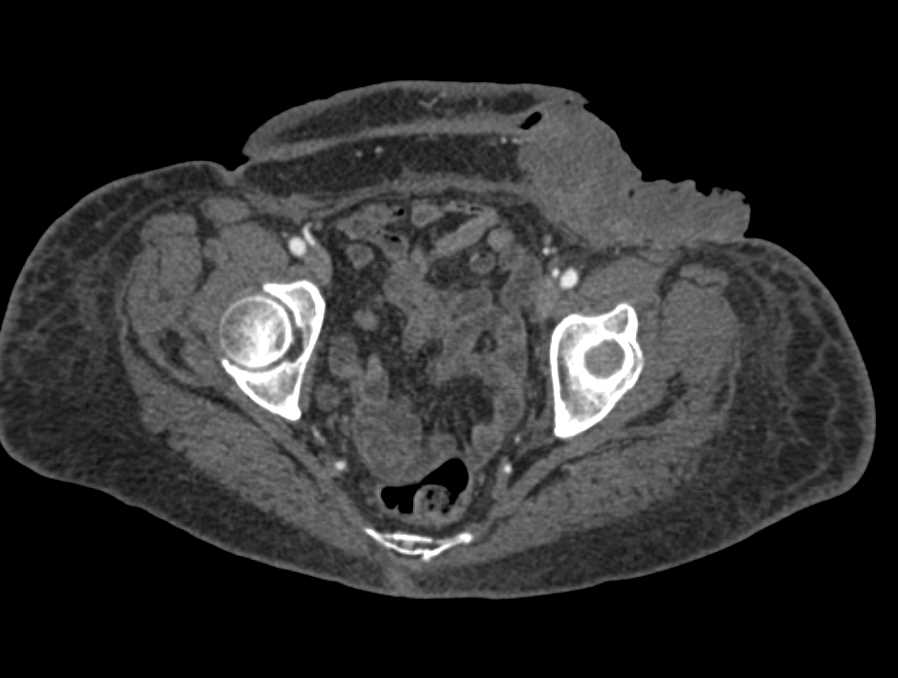 Ulcerating Melanoma Left Groin - CTisus CT Scan